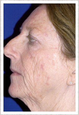 fractional resurfacing