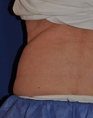 COOLSCULPTING BEFORE AND AFTER on Patient