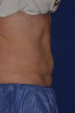 COOLSCULPTING BEFORE AND AFTER on Patient