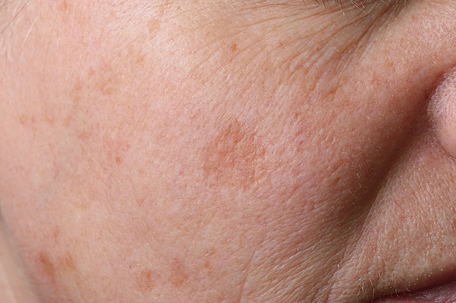 skin pigmentation brown patches