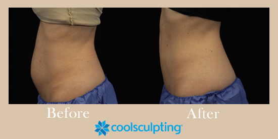 See a before-and-after photo case from a CoolSculpting patient in Tucson.