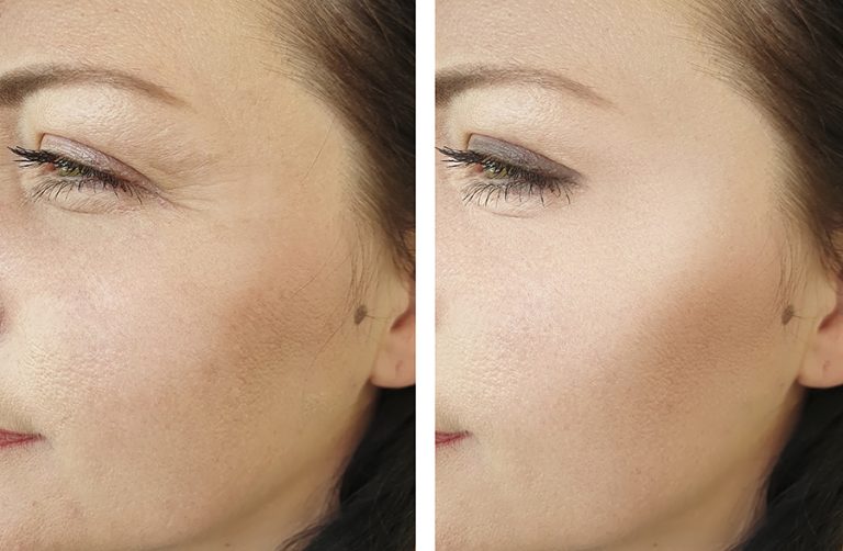 Before and After of woman with eye wrinkles