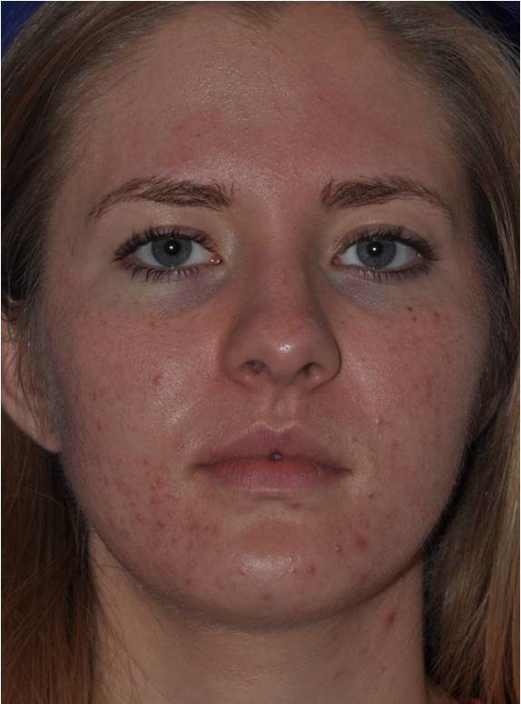 Acne 1 Before