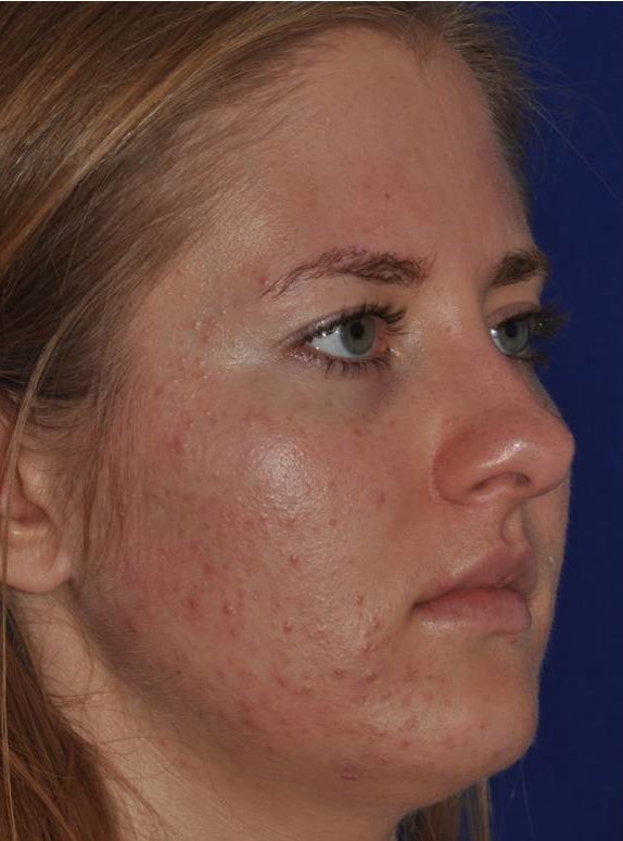 Acne 2 Before