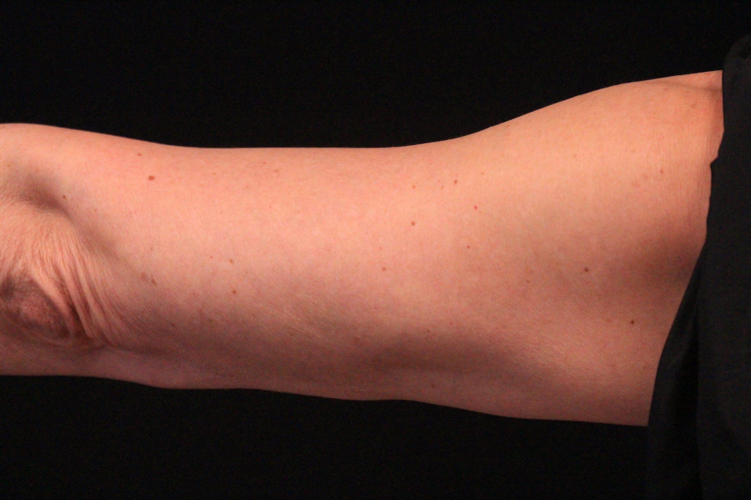 CoolSculpting: Arms 1 After