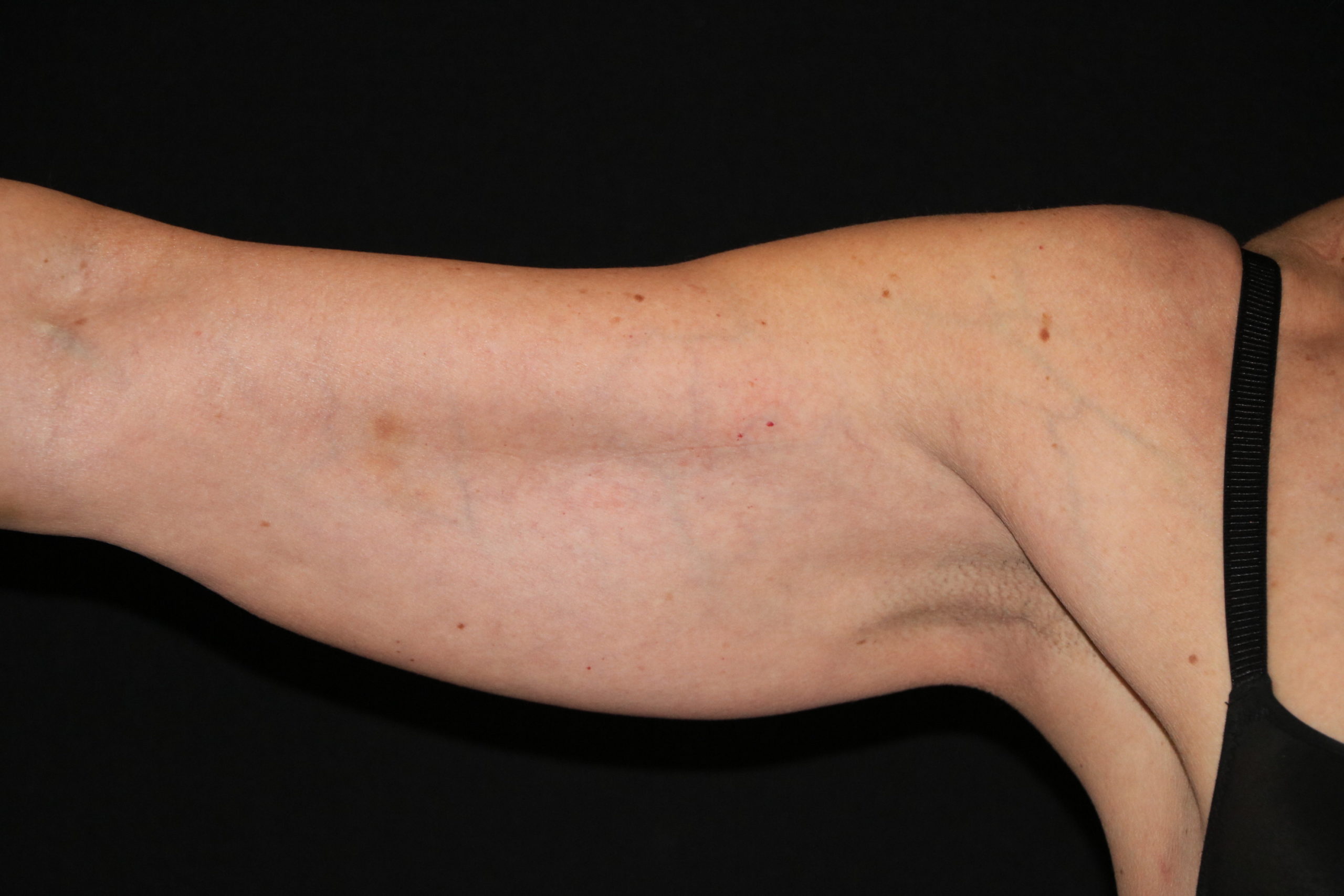 CoolSculpting: Arms 2 Before