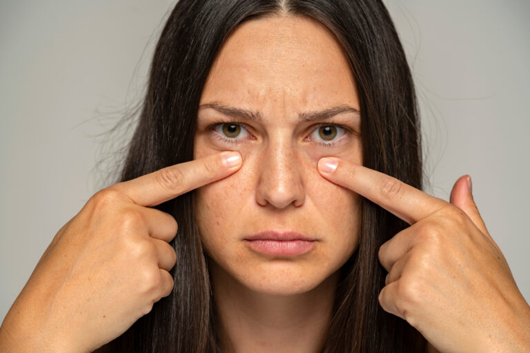 a young unhappy woman touches her undereyes and eyebags